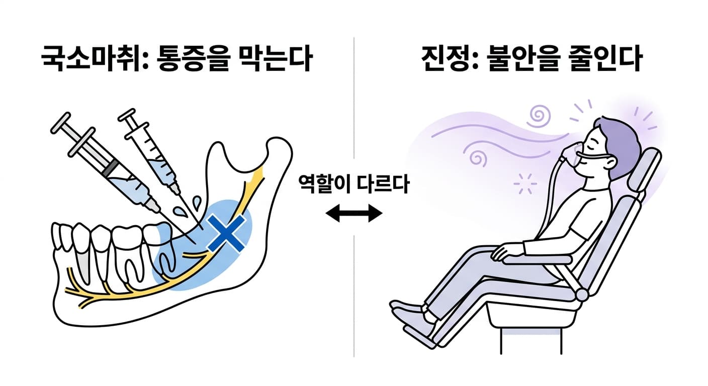 국소마취는 아래턱 신경 주변을 마취해 통증을 막고, 진정은 마스크로 가스를 흡입해 불안을 줄인다는 것을 보여주는 두 패널 비교 그림
