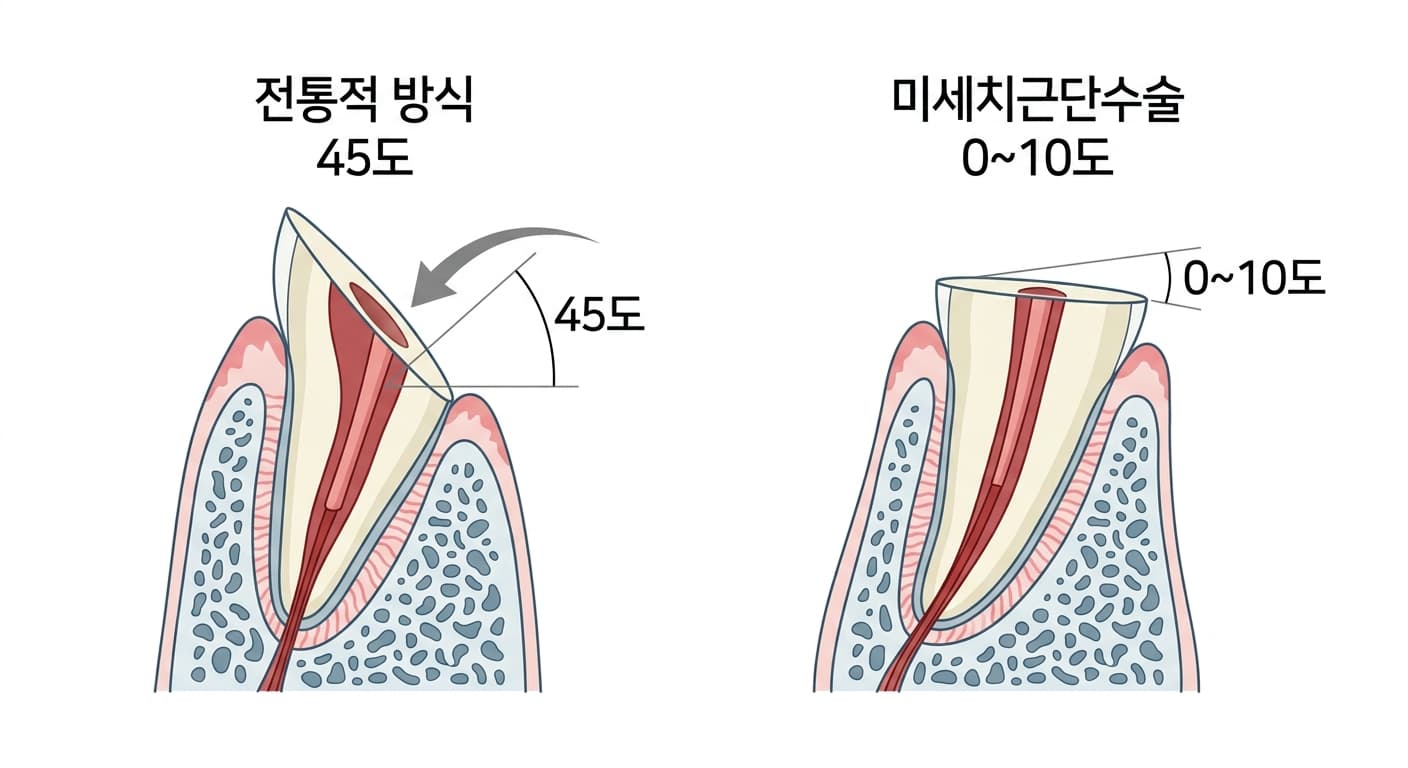 对比传统方式45度与显微根尖手术0~10度根尖切除斜角的截面图