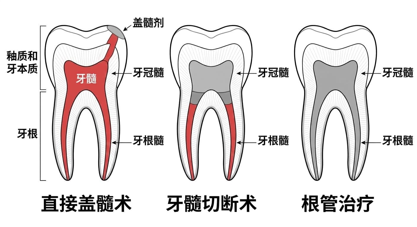直接盖髓术、牙髓切断术、根管治疗中保留或去除的牙髓范围对比的牙齿剖面图