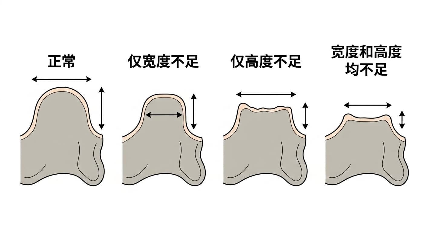 正常牙槽骨与仅宽度不足、仅高度不足、宽度和高度均不足这几种情况的对比图