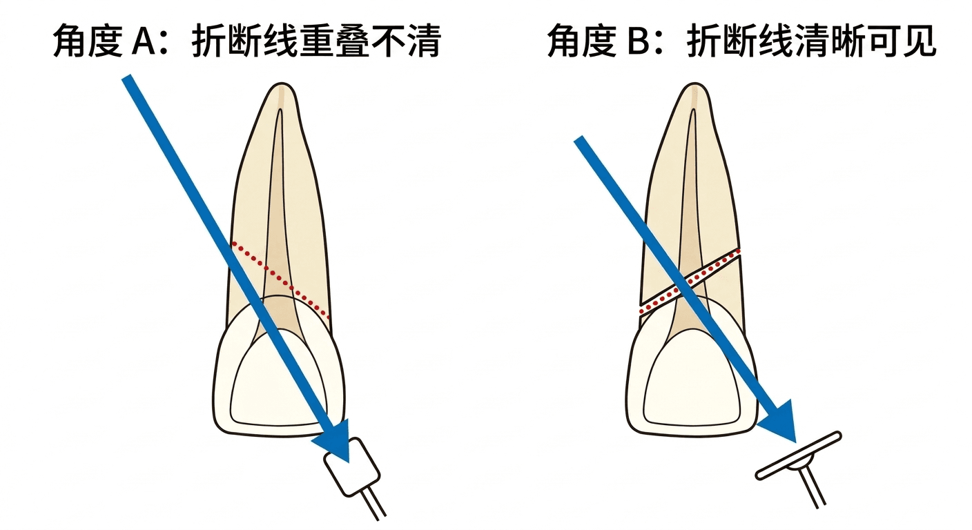 比较X光拍摄角度不同时,斜向牙根折裂线显示重叠或清晰可见的图示